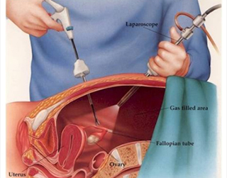 Laparoscopy treatment in vadodara