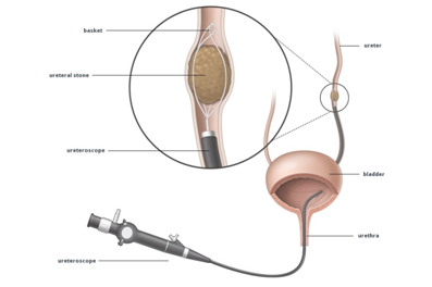 Urology Treatment in vadodara